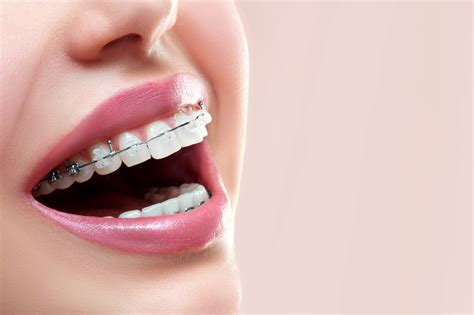 diferencia entre los brackets esteticos y metalicos|champagne vs metal braces.